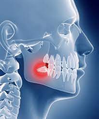 muela-del-juicio Extracción de muelas del juicio: ¿Es necesario esta cirugia?